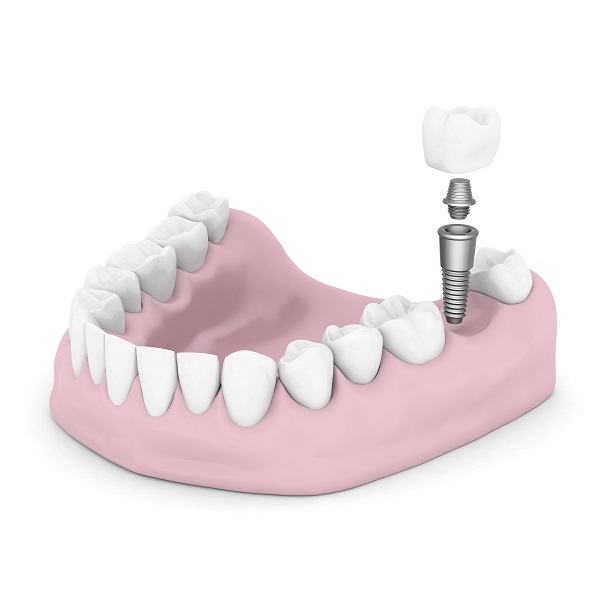 Helpful Things To Know About Multiple Dental Implants